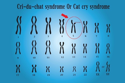 Hội chứng Cri-du-chat (hội chứng mèo kêu)