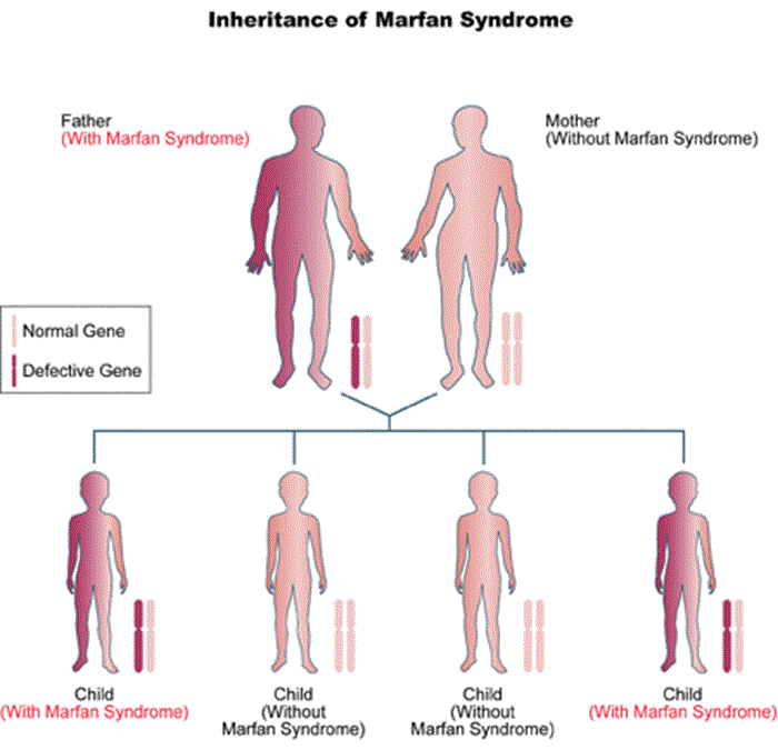 Hội chứng Marfan